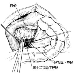 胰头、十二指肠切除术图片