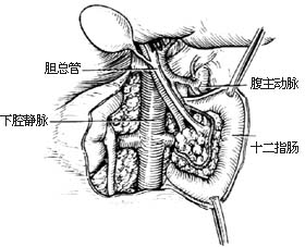 胰头、十二指肠切除术图片