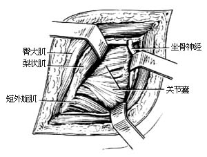 髋关节切开引流术图片