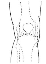 膝关节切开引流术图片