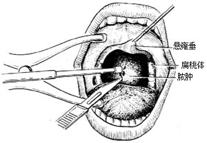 经口腔结核病灶清除术图片