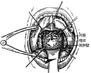 经口腔结核病灶清除术图片