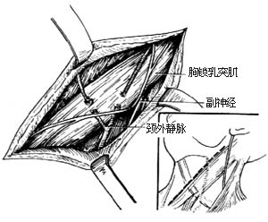 经颈结核病灶清除术图片