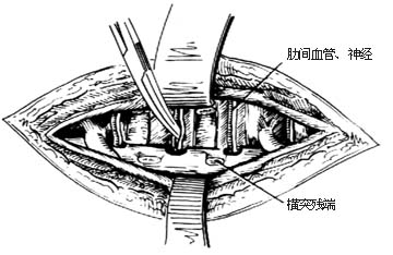 椎管侧壁切除病灶清除减压术图片