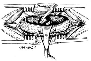 椎板切除病灶清除减压术图片