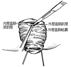 直肠脱垂经会阴切除术图片