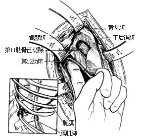 胸腰段脊椎结核病灶清除术图片