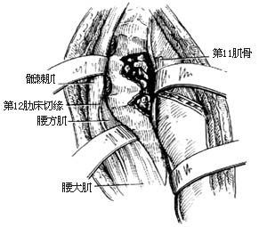 胸腰段脊椎结核病灶清除术图片