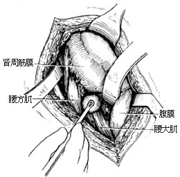 胸腰段脊椎结核病灶清除术图片