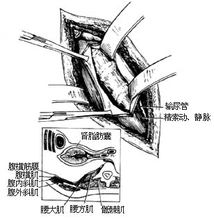 胸腰段脊椎结核病灶清除术图片