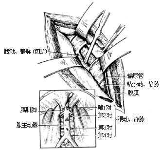 胸腰段脊椎结核病灶清除术图片