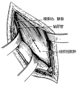 胸腰段脊椎结核病灶清除术图片