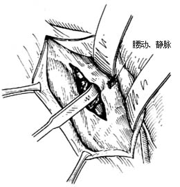 腰骶段脊椎结核病灶清除术图片