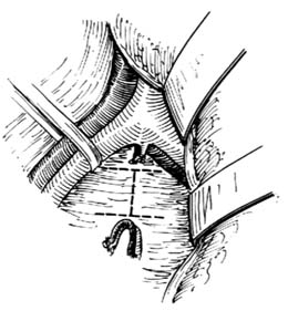 腰骶段脊椎结核病灶清除术图片