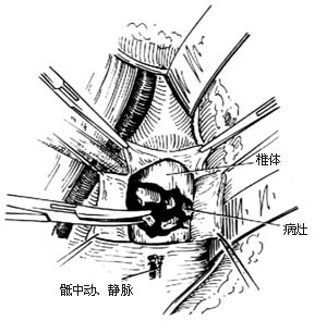 腰骶段脊椎结核病灶清除术图片