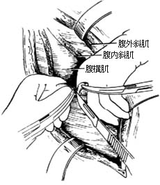 腰骶段脊椎结核病灶清除术图片