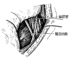 腰骶段脊椎结核病灶清除术图片