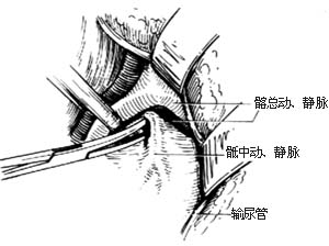 腰骶段脊椎结核病灶清除术图片