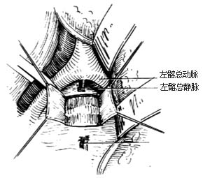 腰骶段脊椎结核病灶清除术图片