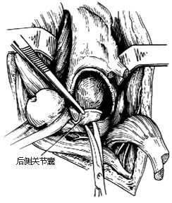 髋关节结核病灶清除术图片