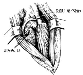 髋关节结核病灶清除术图片