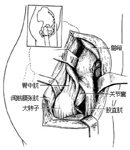 髋关节结核病灶清除术图片