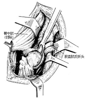 髋关节结核病灶清除术图片