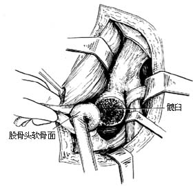 髋关节结核病灶清除术图片