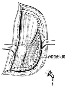 髋关节结核病灶清除术图片