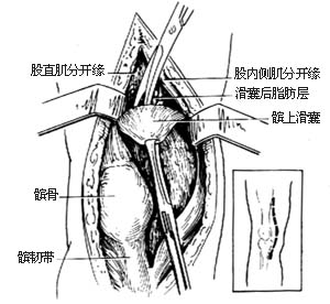 膝关节结核病灶清除术图片