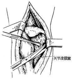 膝关节结核病灶清除术图片