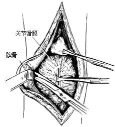 膝关节结核病灶清除术图片