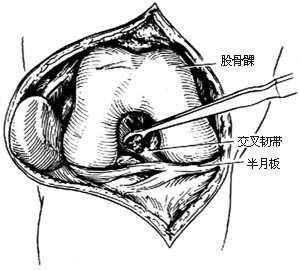 膝关节结核病灶清除术图片