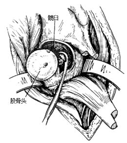 髋关节结核病灶清除术图片