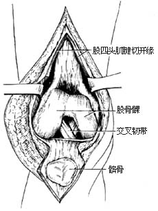 膝关节结核病灶清除术图片
