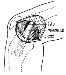 内侧半月板切除术图片