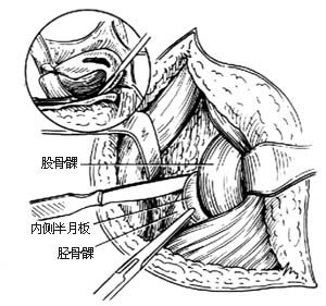 内侧半月板切除术图片