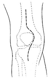 膝关节结核病灶清除术图片