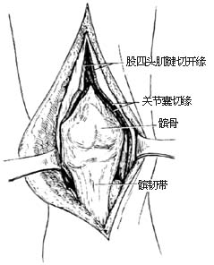 膝关节结核病灶清除术图片