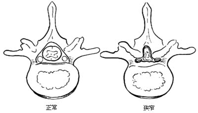 腰椎管、根管扩大减压术图片