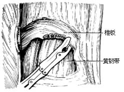 腰椎间盘突出切除术图片