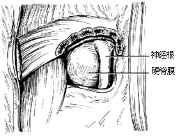 腰椎间盘突出切除术图片