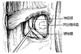 腰椎间盘突出切除术图片