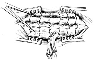 半开门式椎管成形术图片