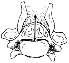 双开门式椎管成形术图片