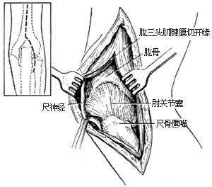 肘关节切除术图片