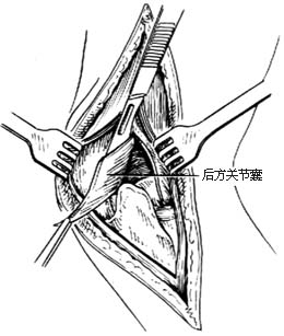 肘关节切除术图片