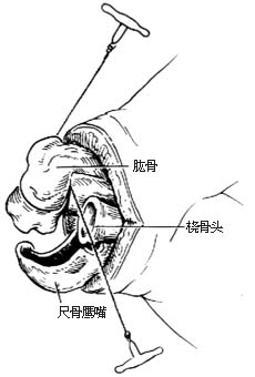 肘关节切除术图片