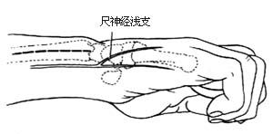 尺骨远段切除术图片