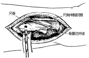 尺骨远段切除术图片